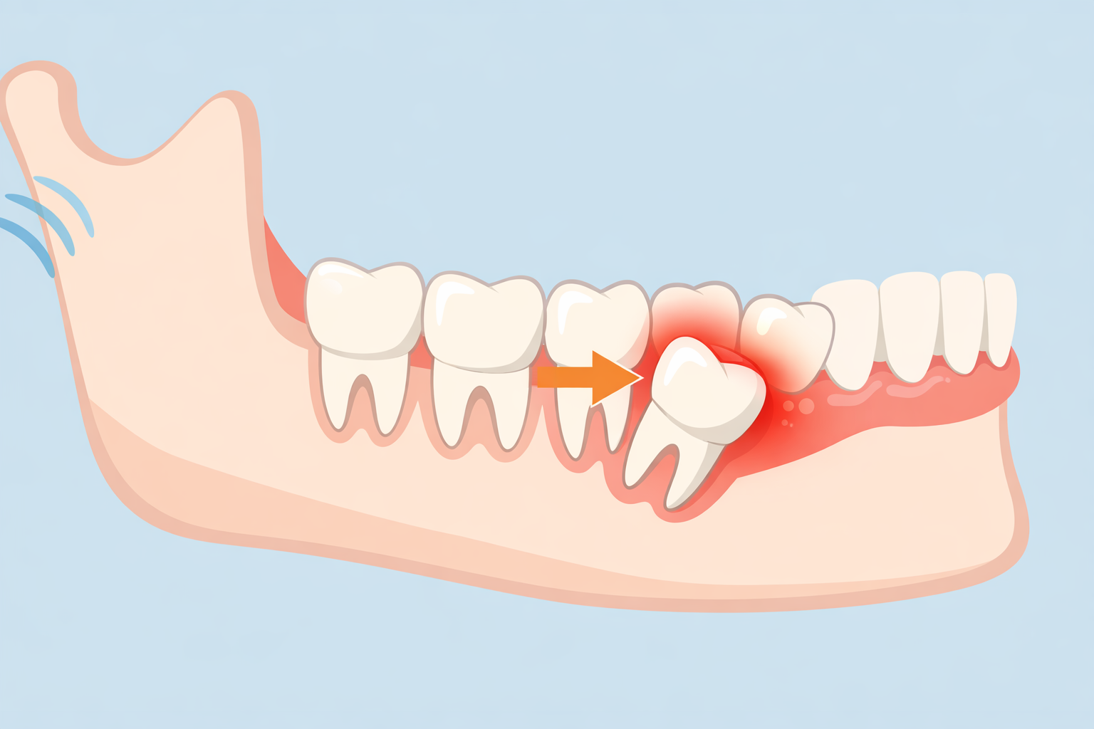 What Really Happens If You Don’t Remove Problem Wisdom Teeth