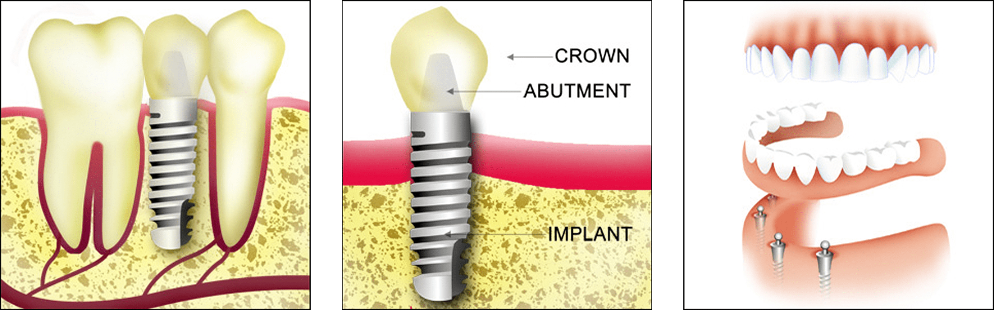 Dental Implant Dental Implant