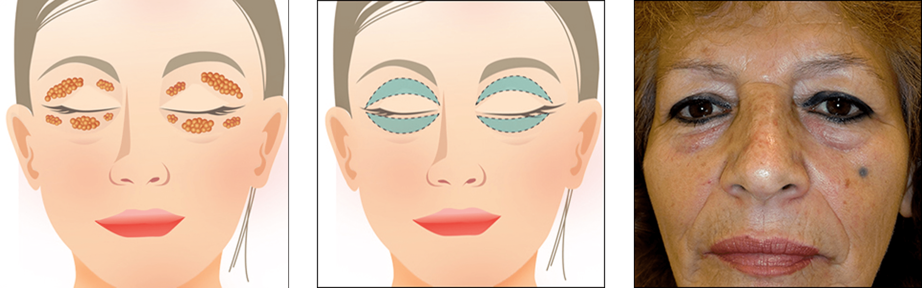 Eyelid Surgery Eyelid Surgery