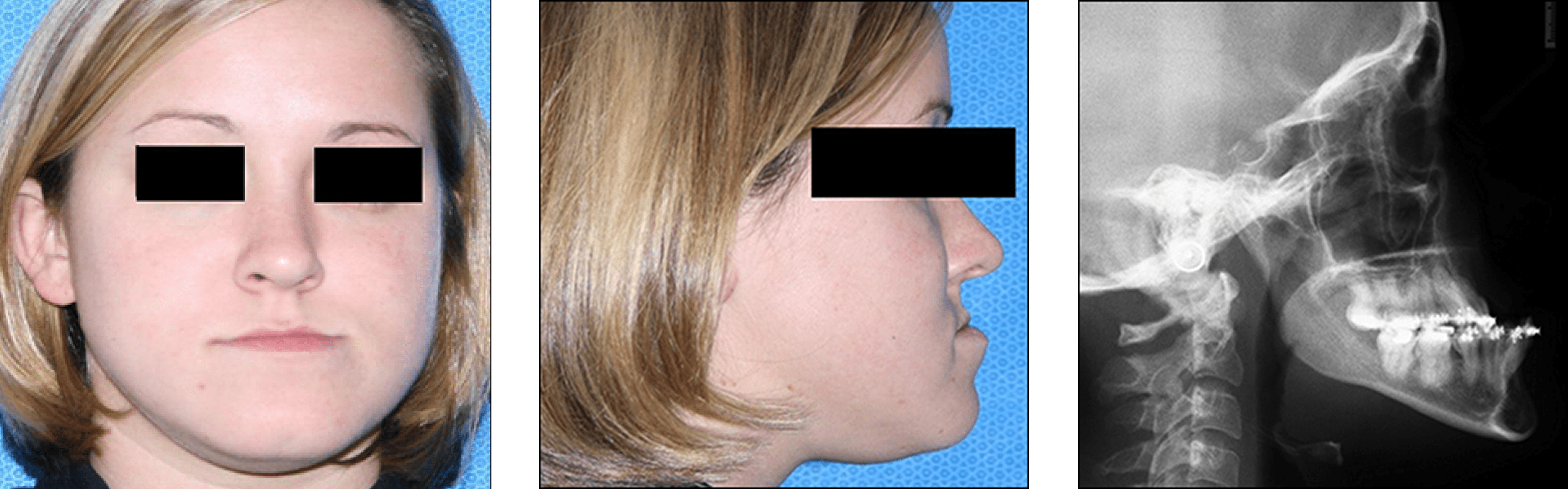 Corrective Jaw Surgery Corrective Jaw Surgery