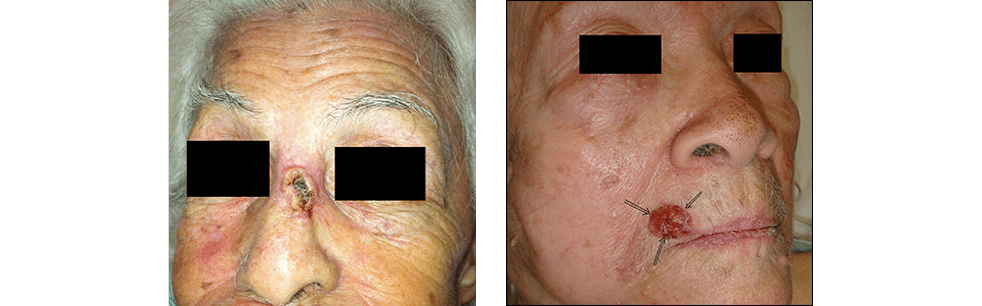 Skin Surgery (Mole and Cancer Removal) Skin Surgery (Mole and Cancer Removal)